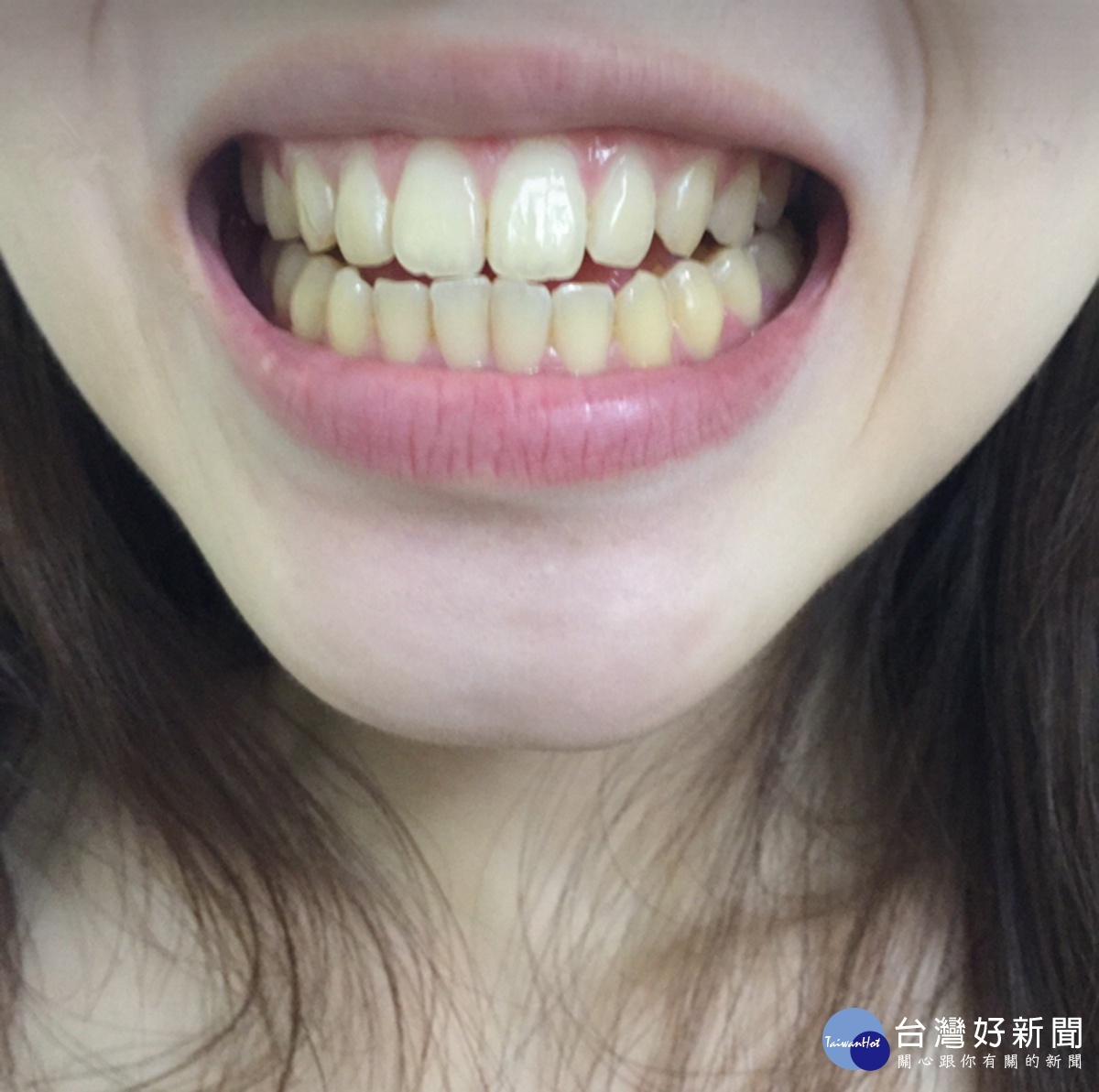 一口黃牙可能讓燦爛笑容造成反效果！不小心還可能造成負面印象！
