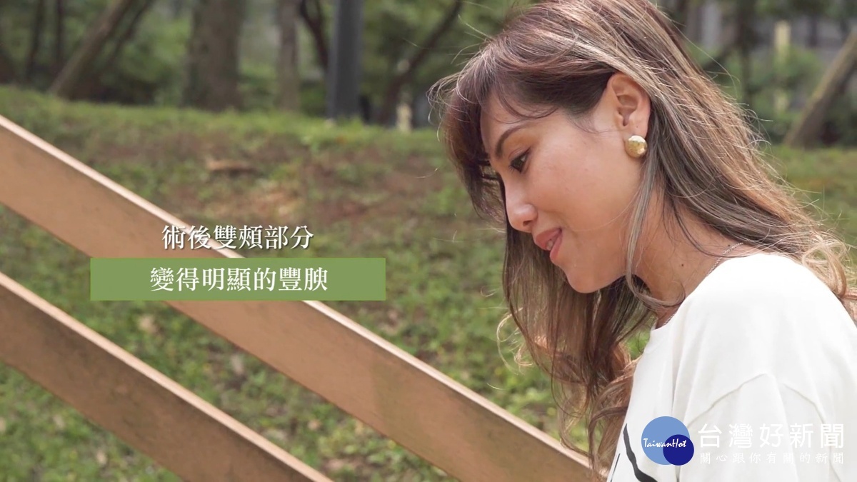 注射完Sculptra舒顏萃3個月後,Elle覺得雙頰豐腴許多。