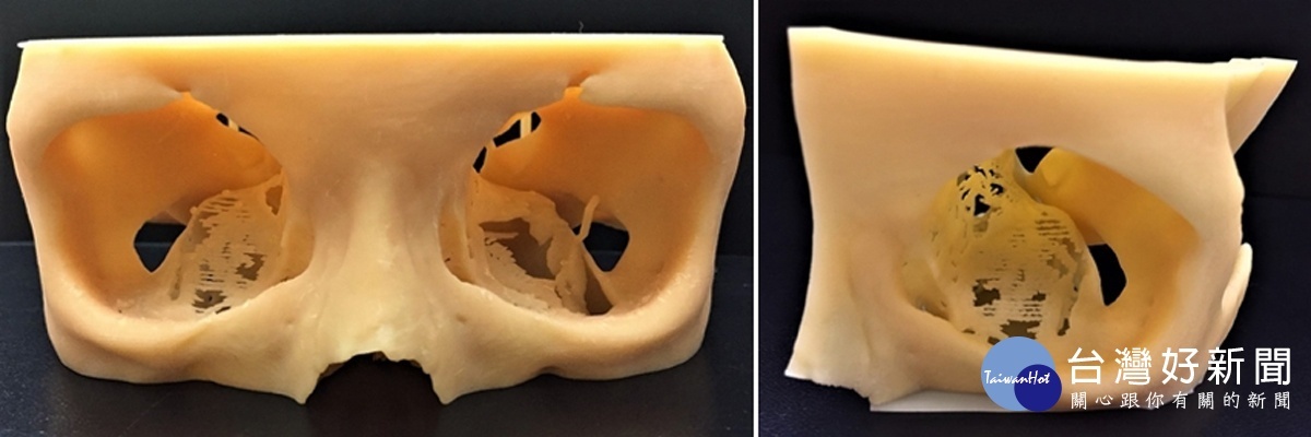 （左）3D列印手術模型；（右）鏡像輸出對側眼窩骨。
