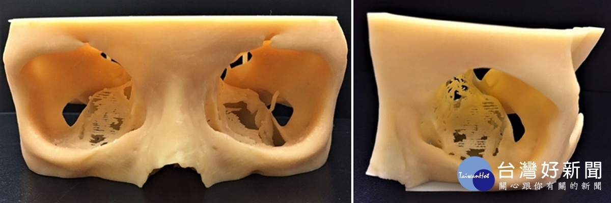 (左)3D列印手術模型;(右)鏡像輸出對側眼窩骨。