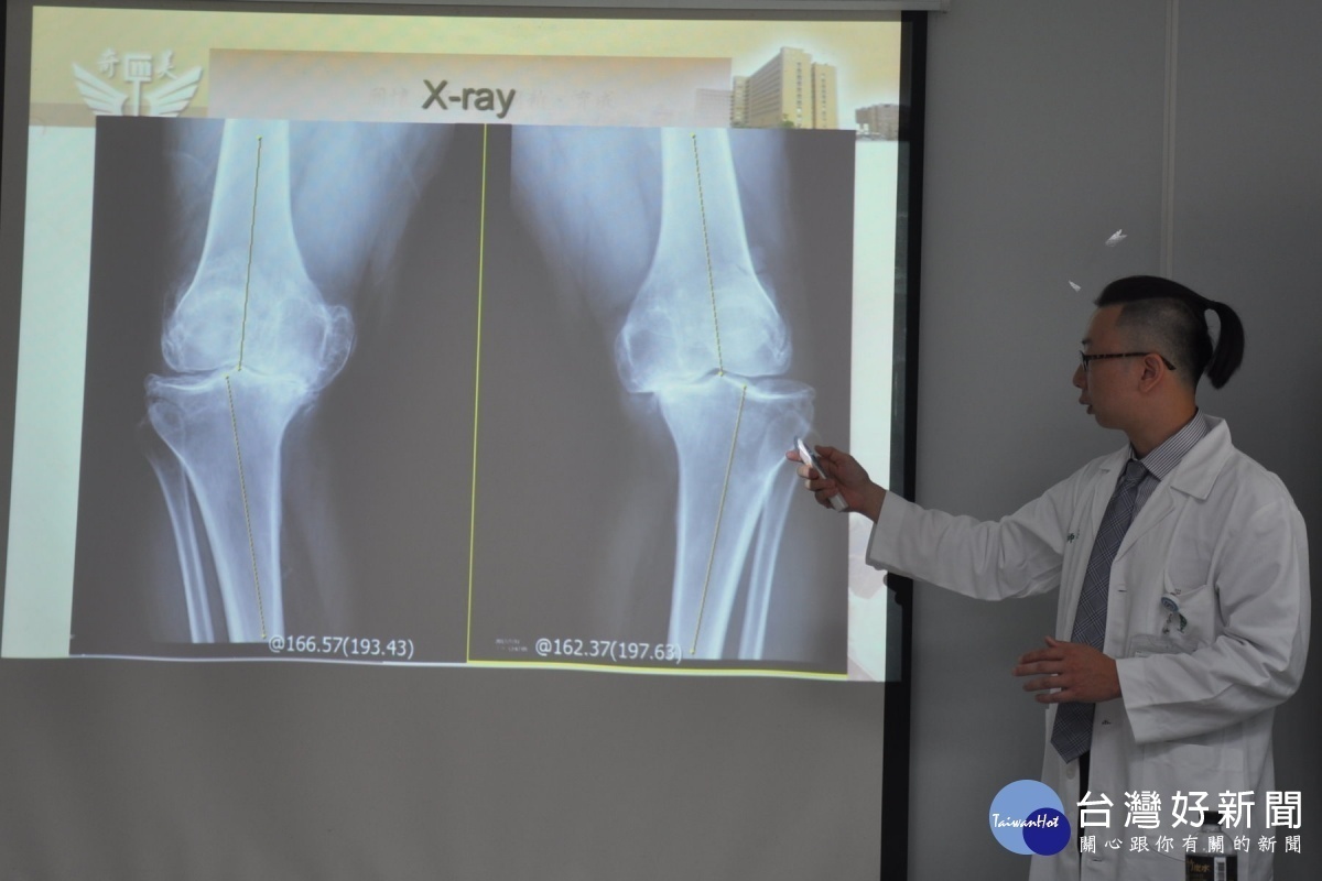 余宗興醫師說明退化性膝關節炎患者雙膝呈O形狀。