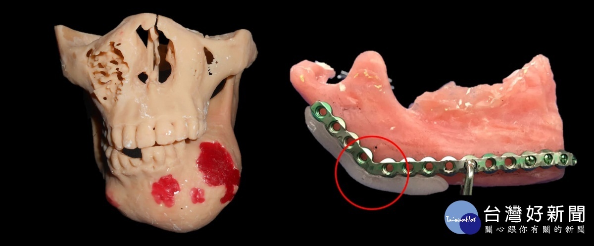 左：3D列印重建病患下顎骨模型；右：於模型上預先客製化骨板及製作導引板。