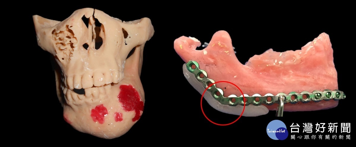 3d列印 下顎骨 跨國援助台廠助菲導入智慧醫療life生