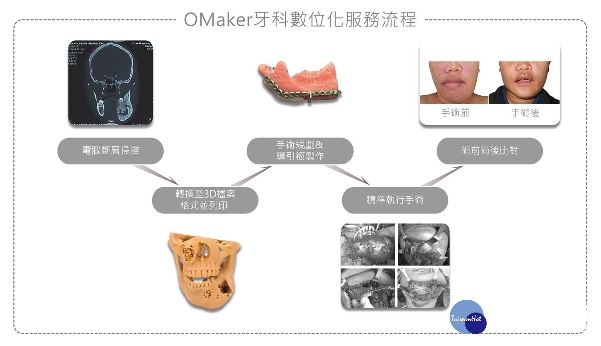 透過OMaker-3D列印，可預先模擬分析，使醫師在面對複雜的顎顏面重建手術上得到不少幫助。