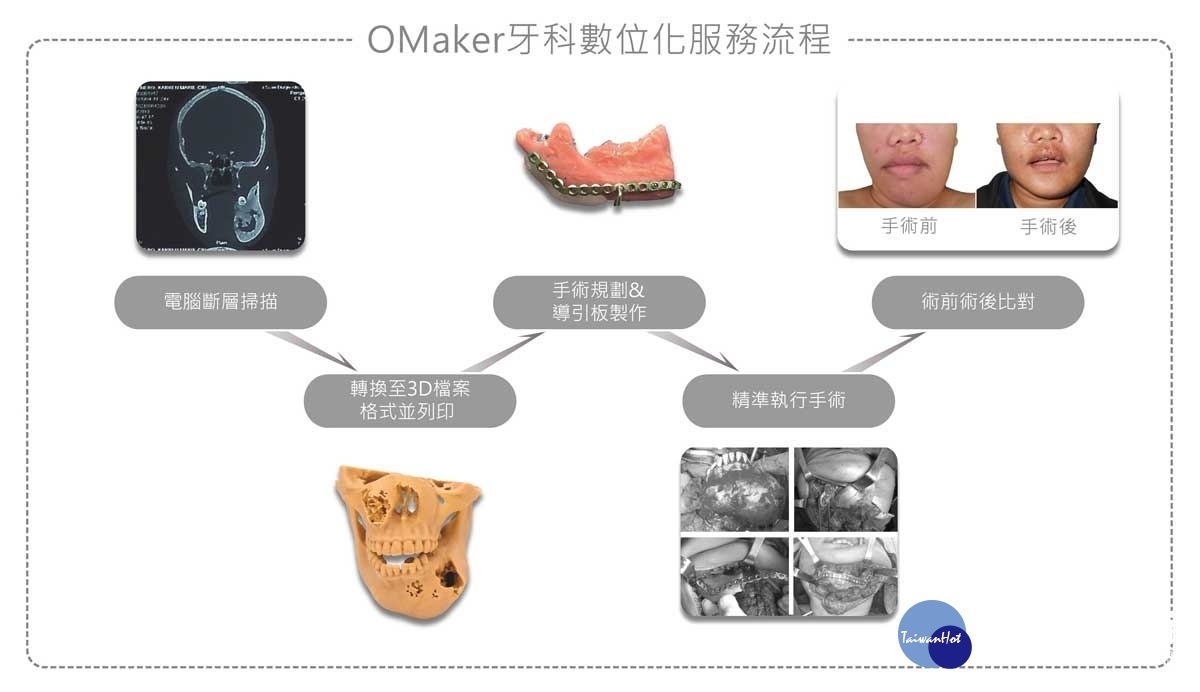透過OMaker-3D列印,可預先模擬分析,使醫師在面對複雜的顎顏面重建手術上得到不少幫助。