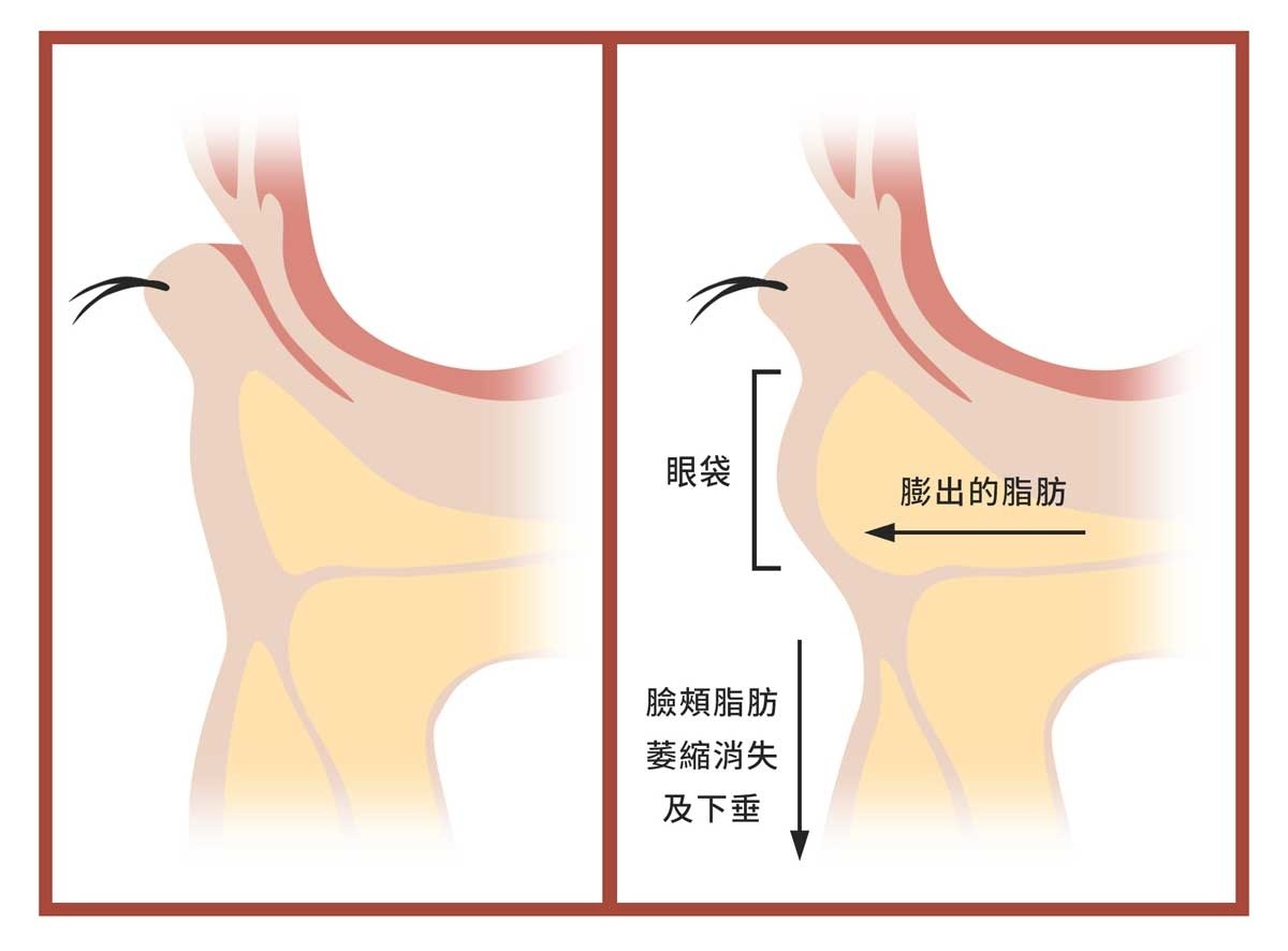 圖左為年輕的眼袋，圖右為老化的眼袋。（圖／丹朵醫學診所提供）