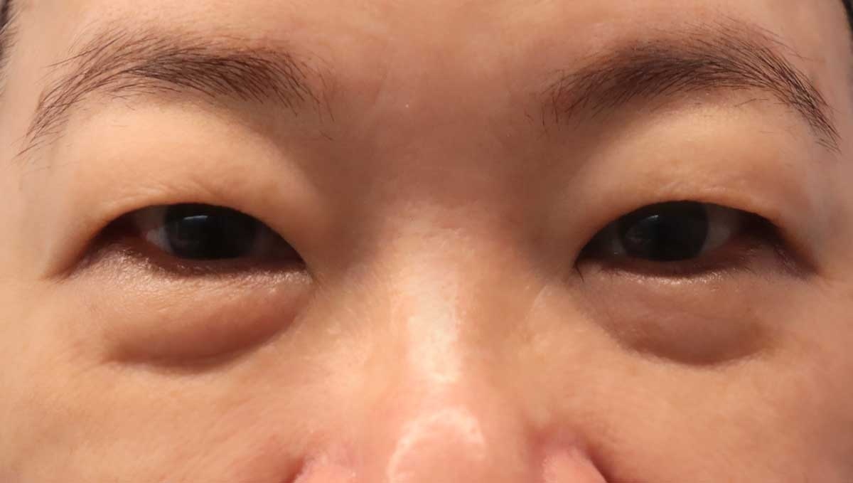 女主管眼袋嚴重,時常看起來沒精神。(圖/丹朵醫學診所提供)