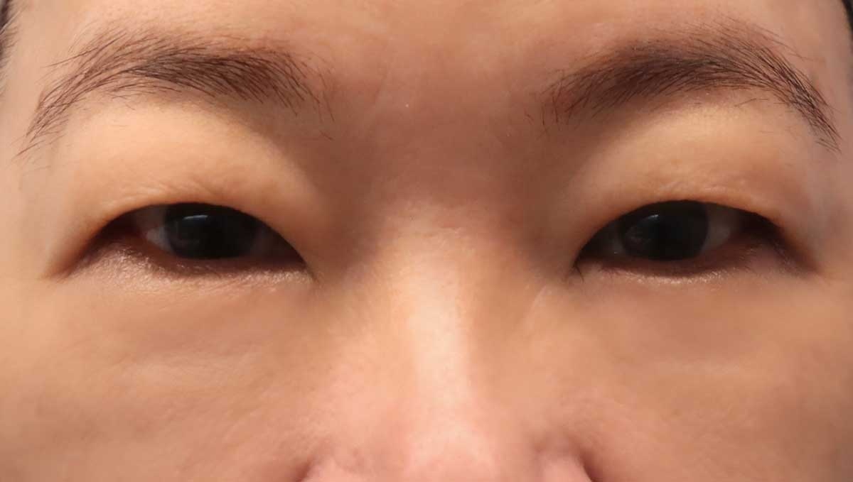 女主管透過「經皮膚眼袋脂肪去除手術」，重拾光彩，切口小，幾乎看不出手術痕跡。（圖／丹朵醫學診所提供）