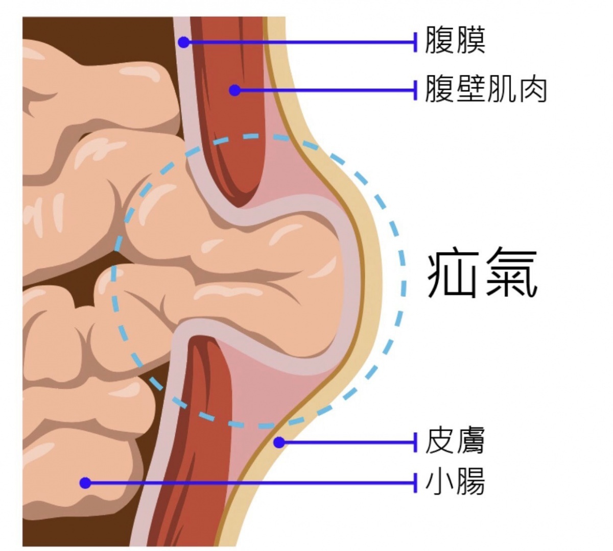 宏恩醫院全方位疝氣中心製作疝氣側面圖解。