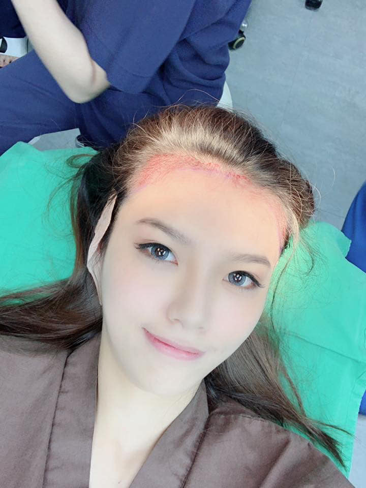 知名網紅美型植髮,植出美人尖的髮際線,臉蛋顯的更小、更精緻。