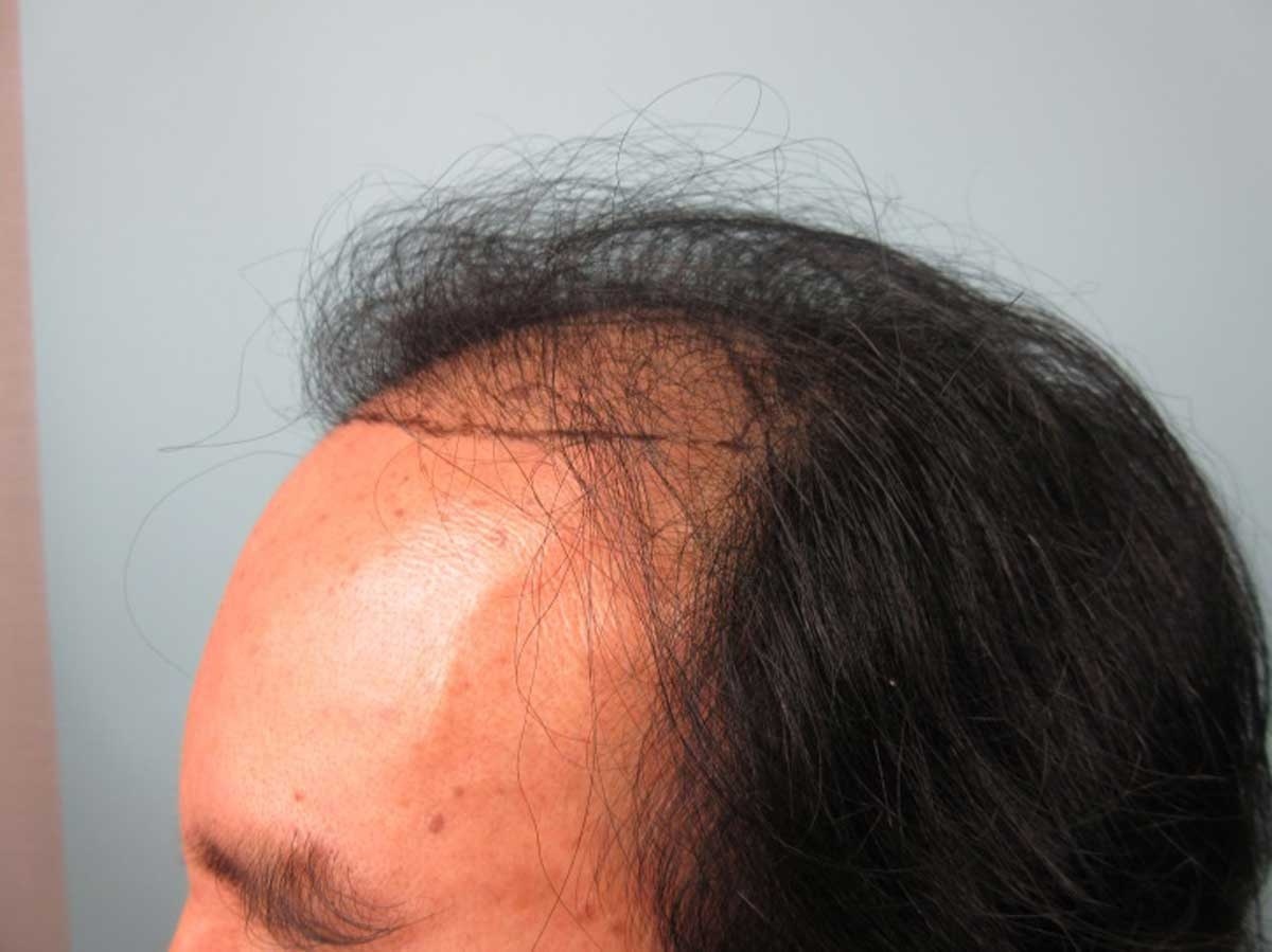 鄭茂發董事長曾接受過傳統植髮手術，禿頭部位依舊清晰可見。