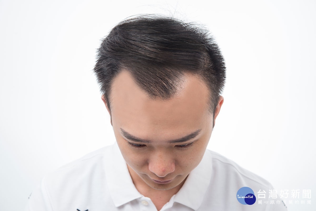 從事房仲業務工作的澤澤,植髮前與專業醫師充份討論後做ARTAS植髮手術。