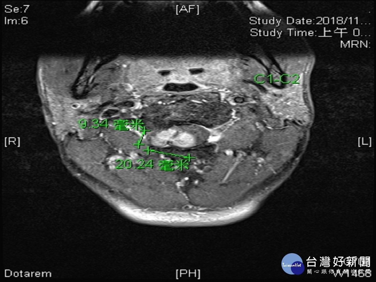 越籍男子高位頸椎腫瘤壓迫險癱瘓　彰基借顯微影像手術成功治癒