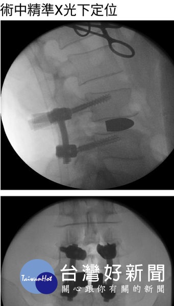 龍骨創傷免驚　微創固定減壓融合手術助診治 台灣好新聞 第2張