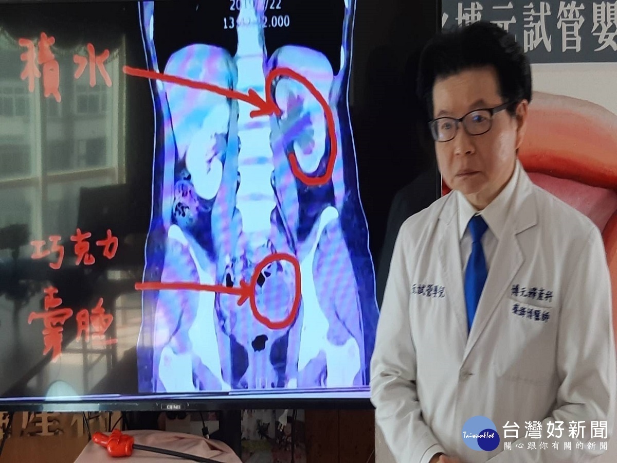 巧克力囊腫竟然引起腎臟淹大水 醫師:嚴重者恐影響生育能力