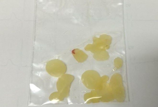 抽吸出來的淡黃色米粒狀脂肪球組織。圖／彰化醫院提供
