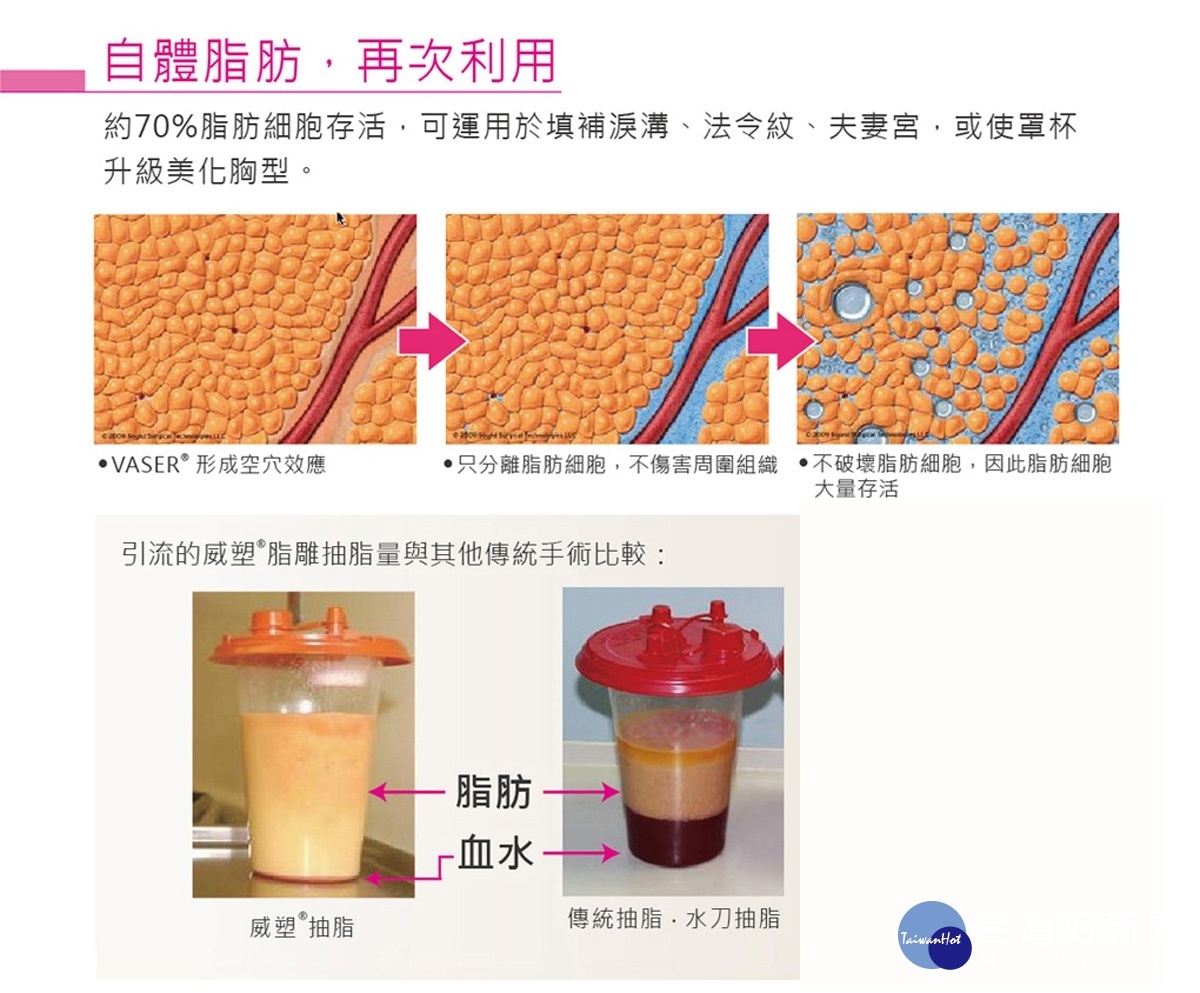 威塑抽脂方式可以讓自體脂肪再次利用，運用於精緻臉部或是雕塑身材曲線。（圖／佳醫美人提供）