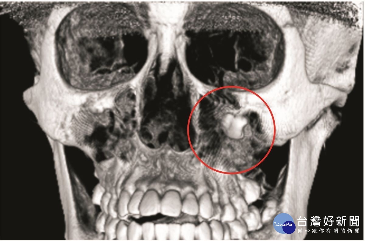蘇竣揚表示，那顆智齒非常深，長在左眼眶下緣，巨大的囊腫佔據了整個上顎鼻竇。