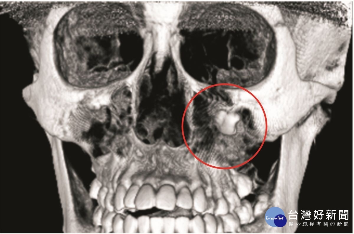 阻生智齒躲在左眼下　高三女顏面蜂窩性組織炎 台灣好新聞 第2張