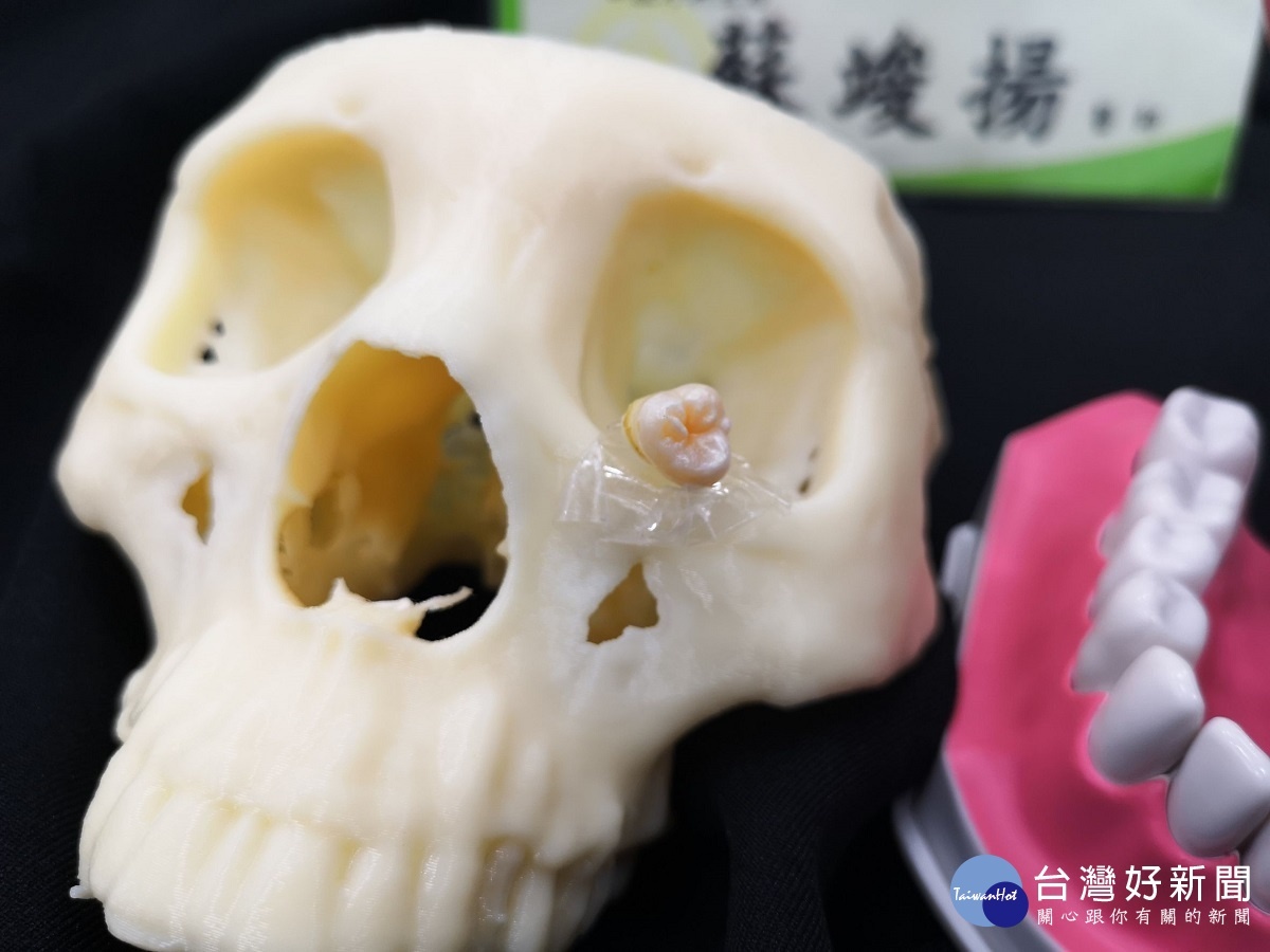 患者的智齒非常深,長在左眼眶下緣,巨大的囊腫佔據了整個上顎鼻竇。