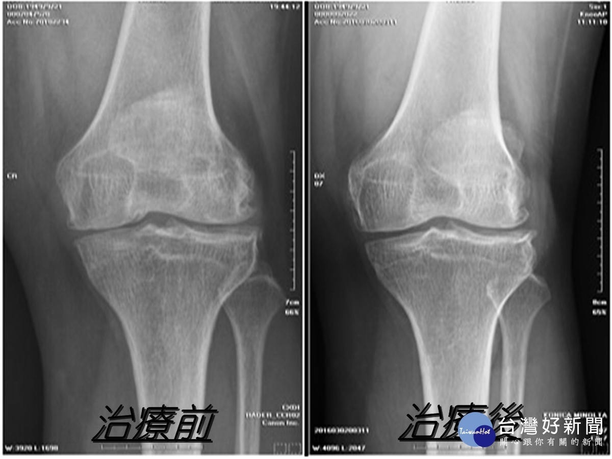 北榮桃醫增生療法改善膝蓋化    肌骨超音波導引注射成效顯著 台灣好新聞 第3張