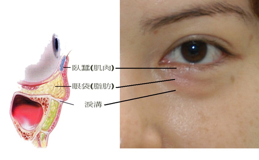 眼袋與淚溝的產生讓衰老情形更加明顯，是愛美人士的一大痛傷。（圖／風華整形診所提供）