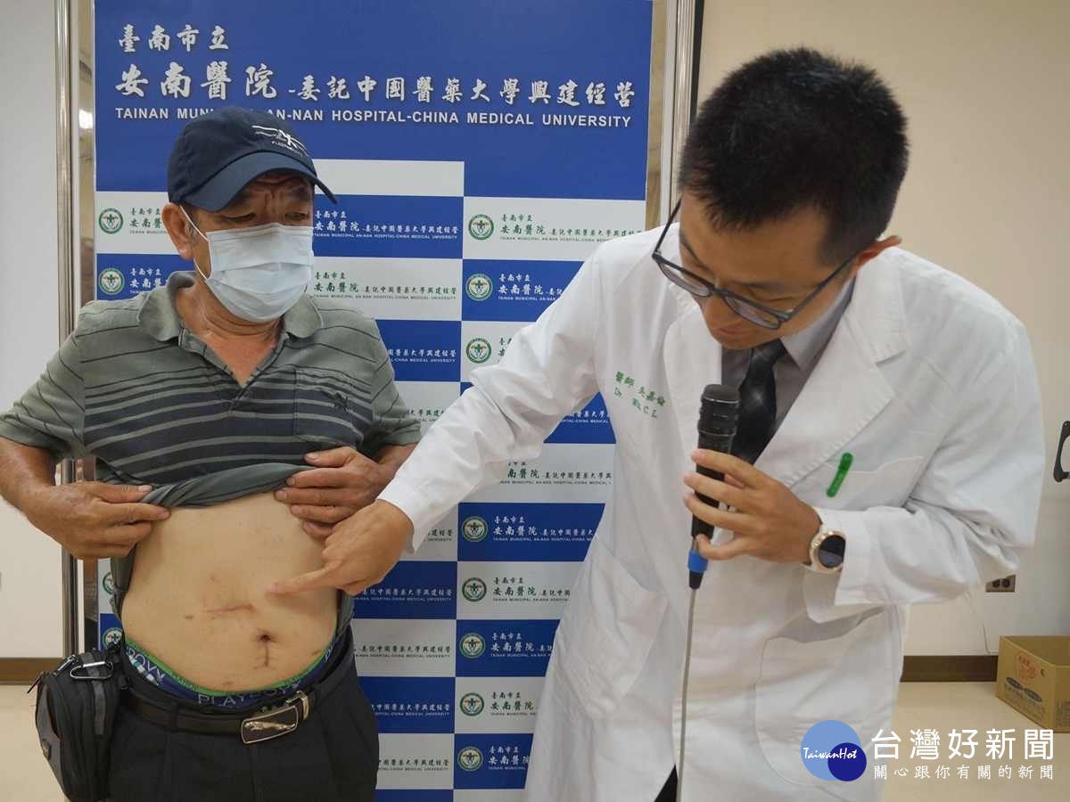 腹腔鏡大腸腫瘤切除手術　一術雙切雙腫瘤同步腸道重建 台灣好新聞 第1張
