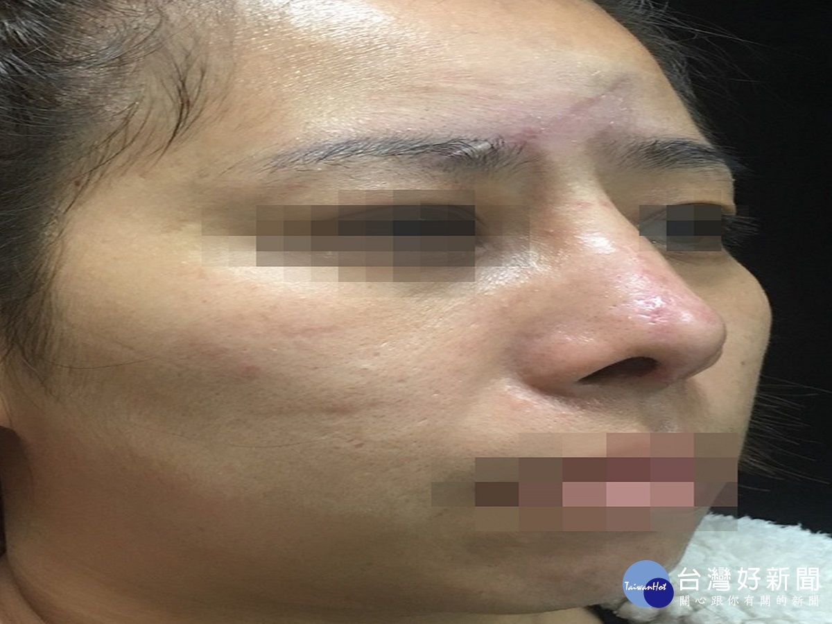 女子跌倒臉部險毀容　醫師進行「喬臉」耳臀全用上 台灣好新聞 第3張