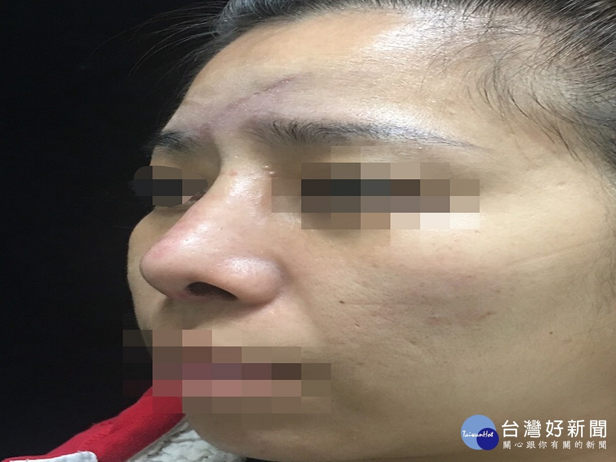 女子跌倒臉部險毀容　醫師進行「喬臉」耳臀全用上 台灣好新聞 第2張
