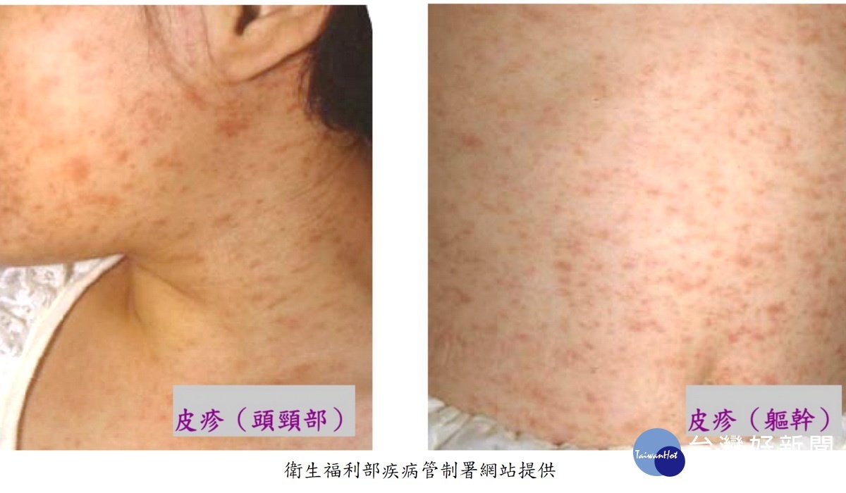 麻疹案例圖片。（衛生局提供）