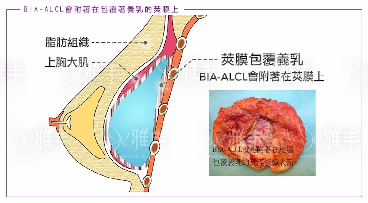 FDA、食藥署要求回收美國大品牌絨毛面義乳　張松源醫師呼籲定期乳房檢查 台灣好新聞 第2張