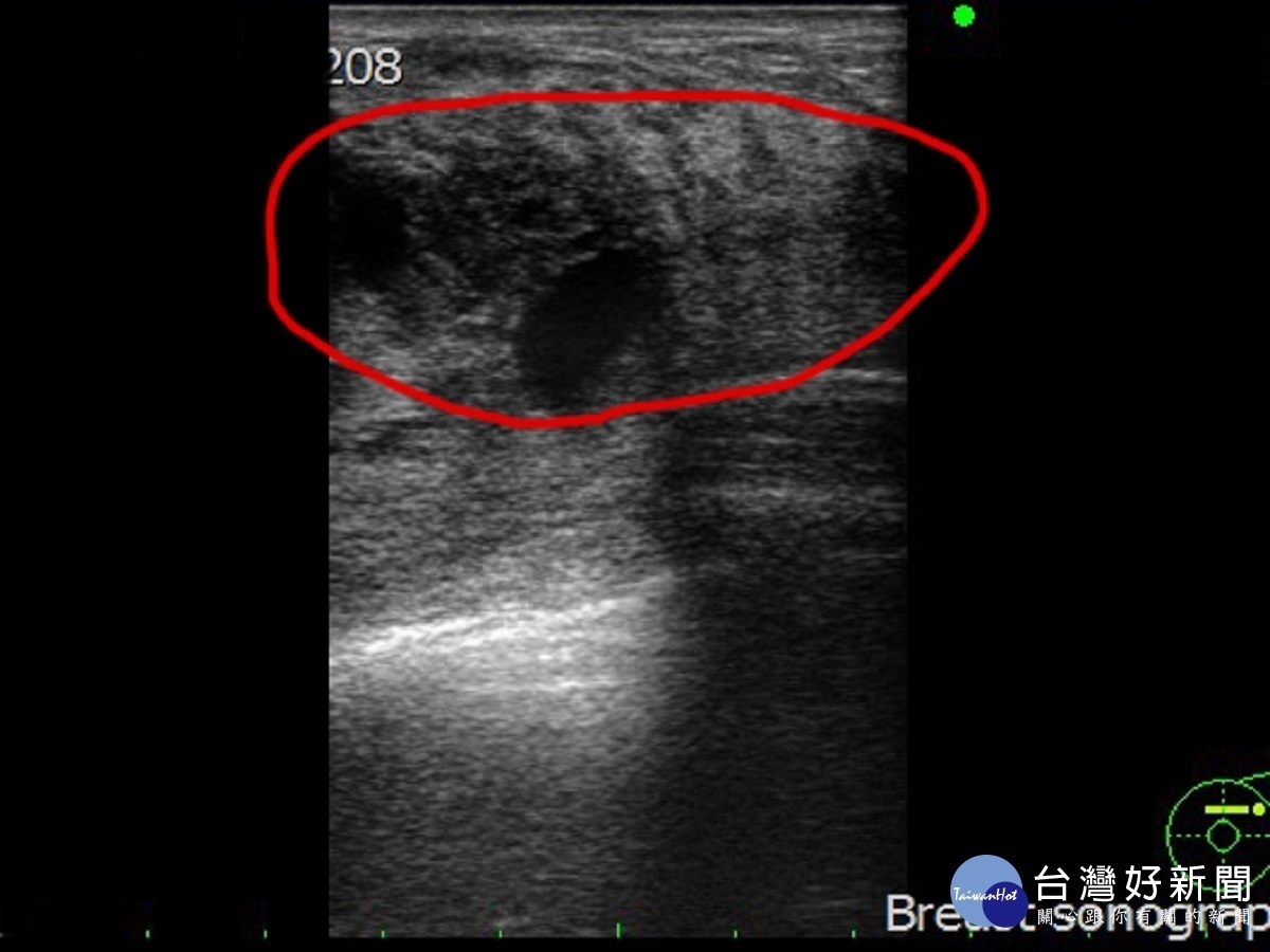 婦人乳房紅腫以為撞傷　檢查發現竟是乳癌