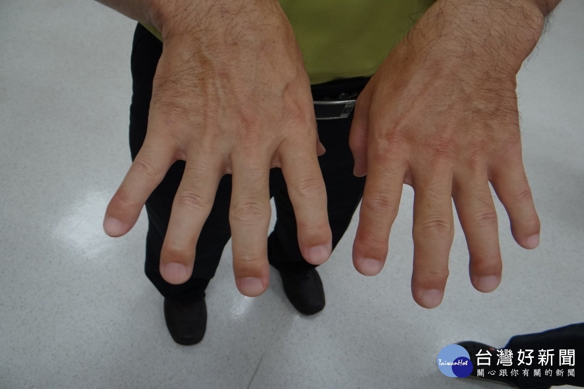 經治療後，手指端已恢復正常。