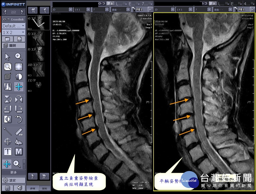60歲的傅先生接受動態負重磁振造影(MRI)檢查。圖/彰化秀傳醫院提供