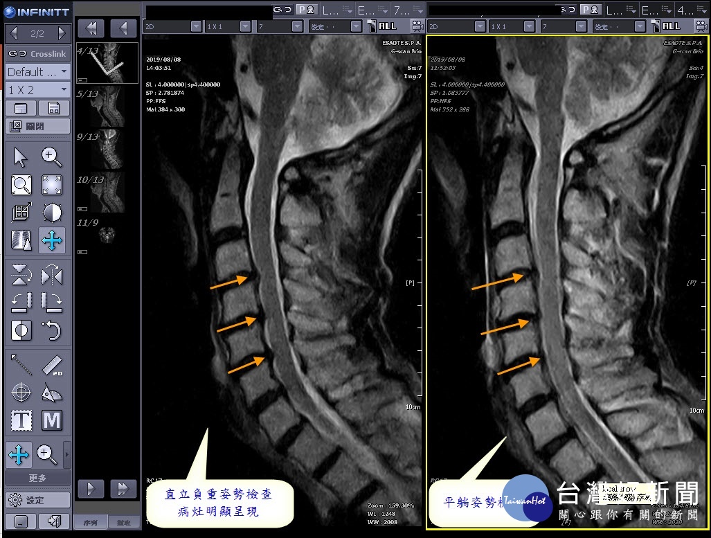 60歲的傅先生接受動態負重磁振造影(MRI)檢查。圖／彰化秀傳醫院提供