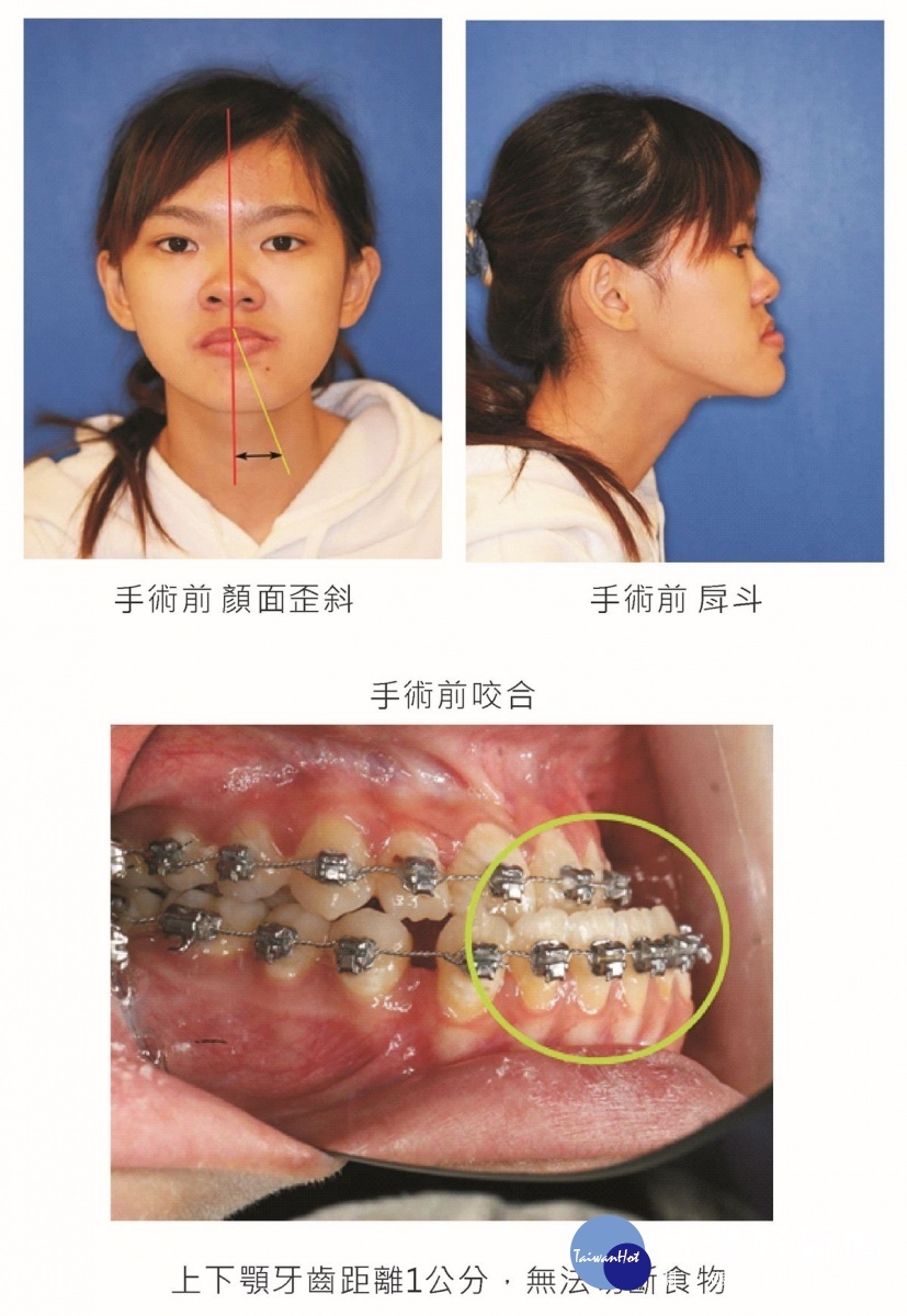 小靜顏面、上下顎咬合 - 手術前後。