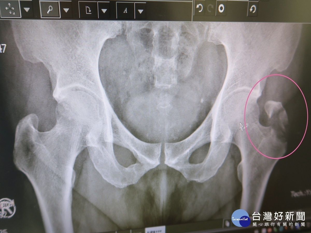 男子下樓滑倒左髖骨裂位移　醫師：疼痛超過2週一定要持續追蹤