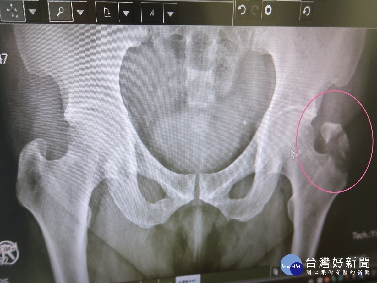男子下樓滑倒左髖骨裂位移 醫師:疼痛超過2週一定要持續追蹤