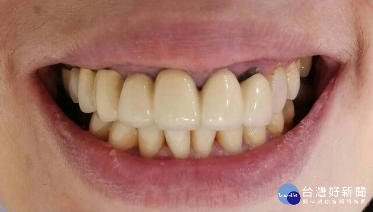 傳統假牙，產生牙齦變黑，牙根腐壞的問題。
