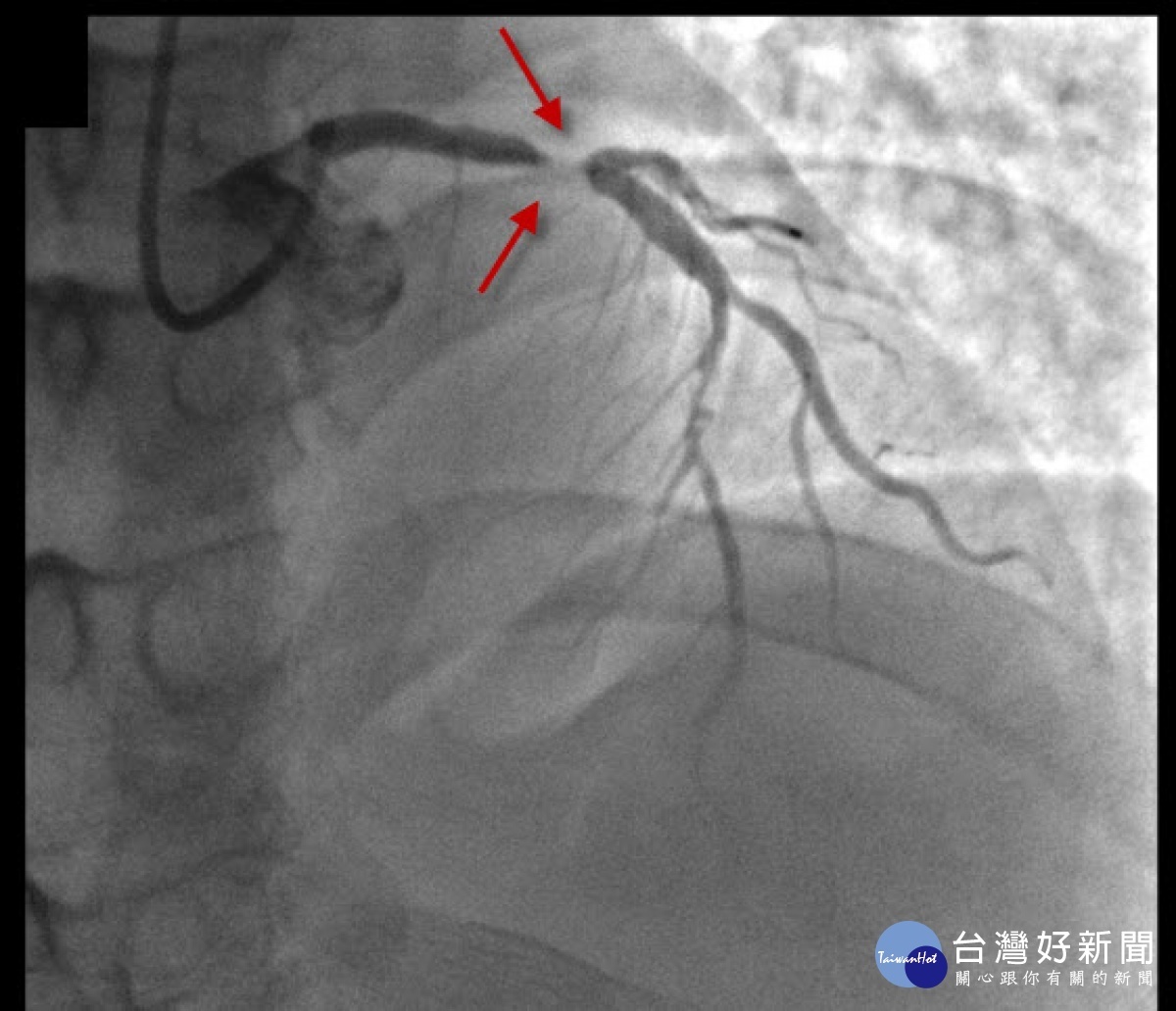 患者林俊吉心導管阻塞圖。圖／彰化秀傳醫院提供