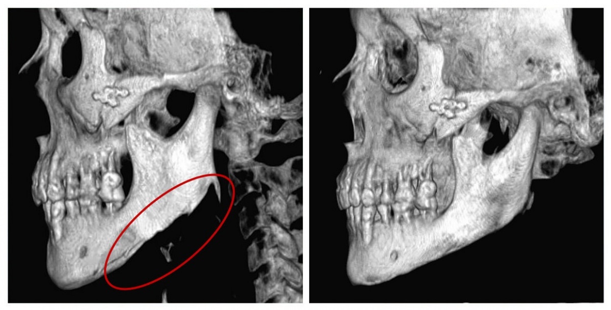 病患第一次削骨術後拍攝的臉部頭骨電腦斷層，下顎骨竟成鋸齒狀如「狗啃」(左)，郭菁松醫師替病患進行二次削骨重建手術後，下顎骨恢復成正常狀態(右)。