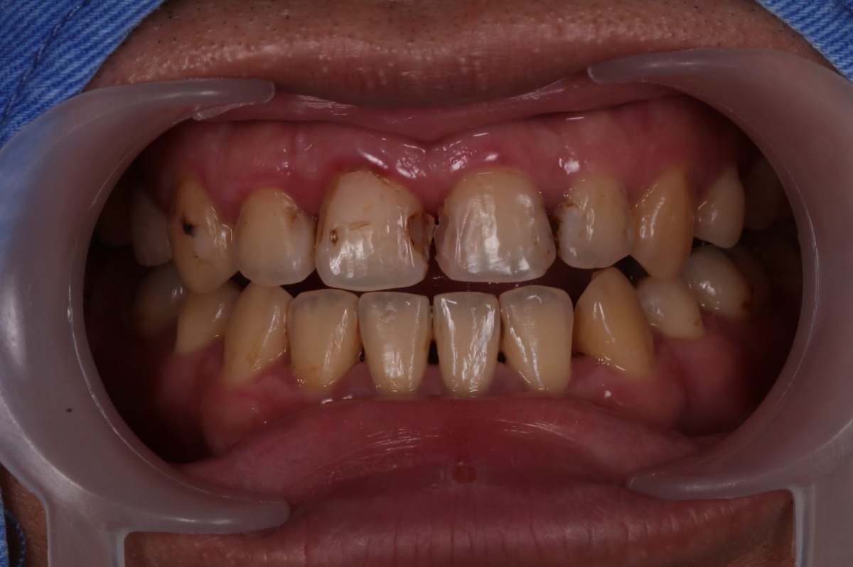 牙齒變色嚴重、齒縫間隙大。（圖／賴建宇醫師提供）