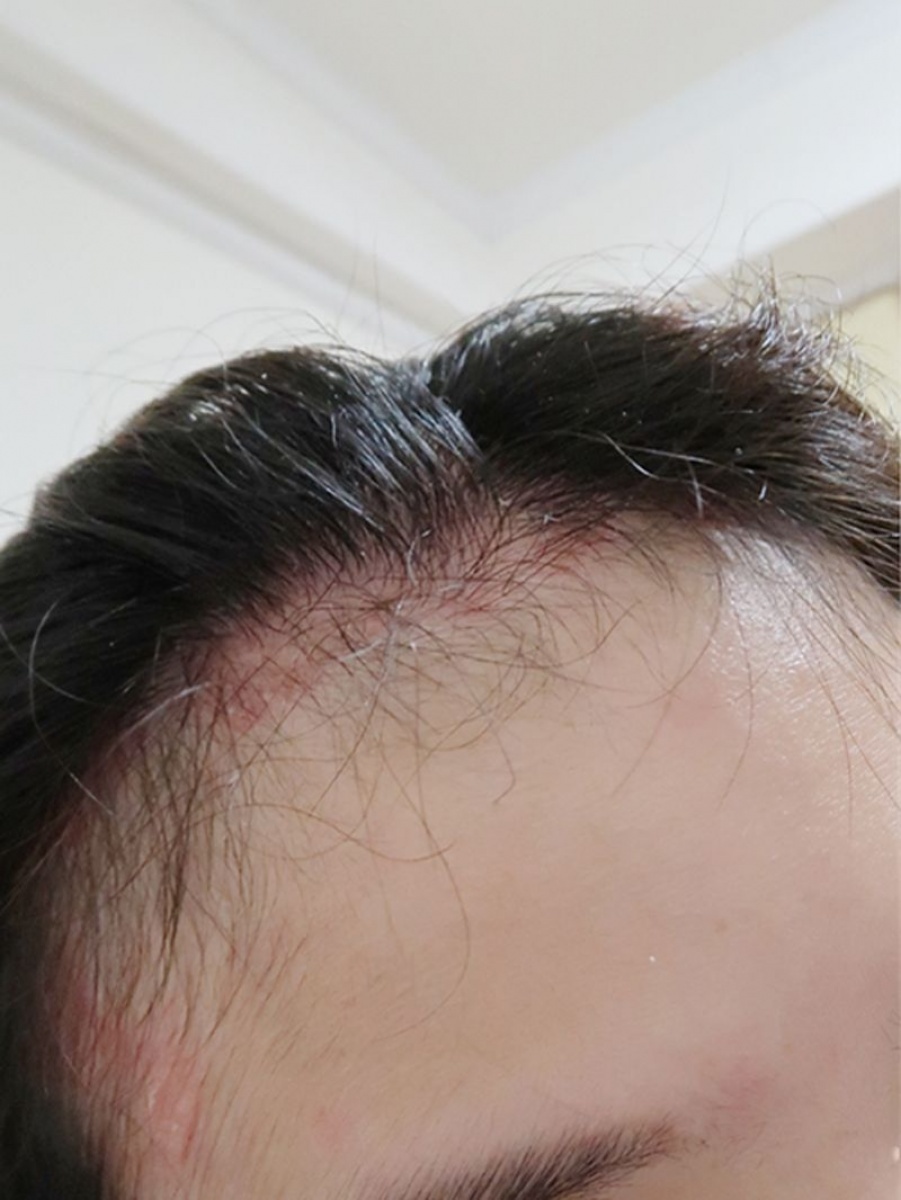 網友表示有脂肉性皮膚炎洗髮精很難選。