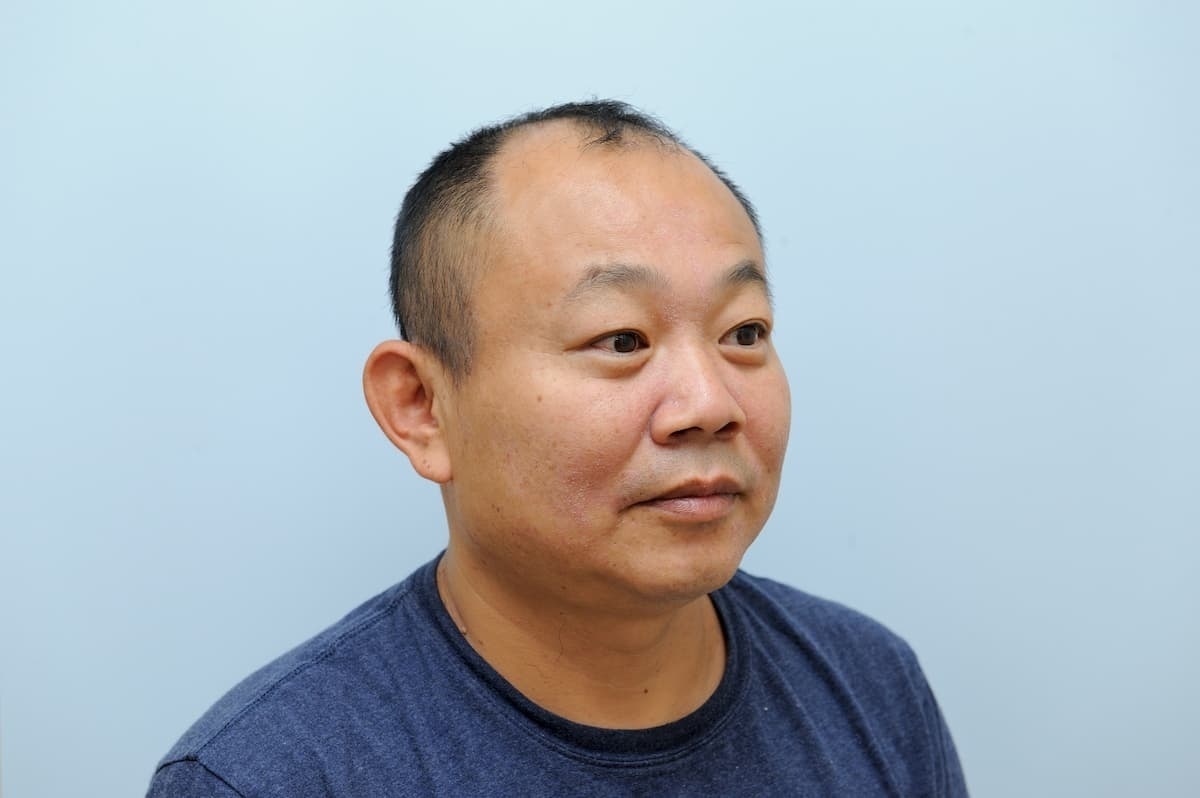 戲說台灣製作人鄭志偉,植髮前後3000株。