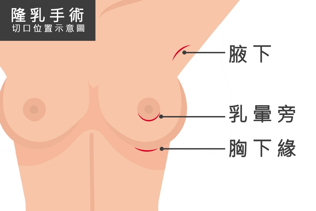 隆乳手術切口位置示意圖。