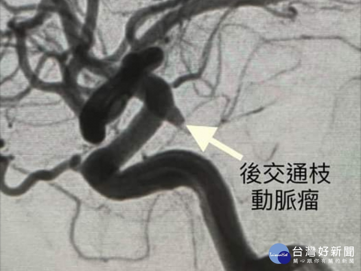 舉杯邀明月對影成三人 腦血管動脈瘤不可不慎