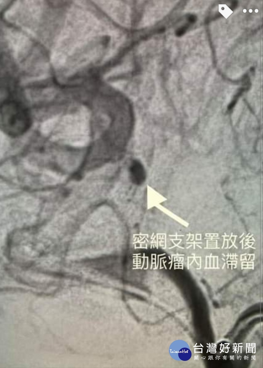 舉杯邀明月對影成三人 腦血管動脈瘤不可不慎