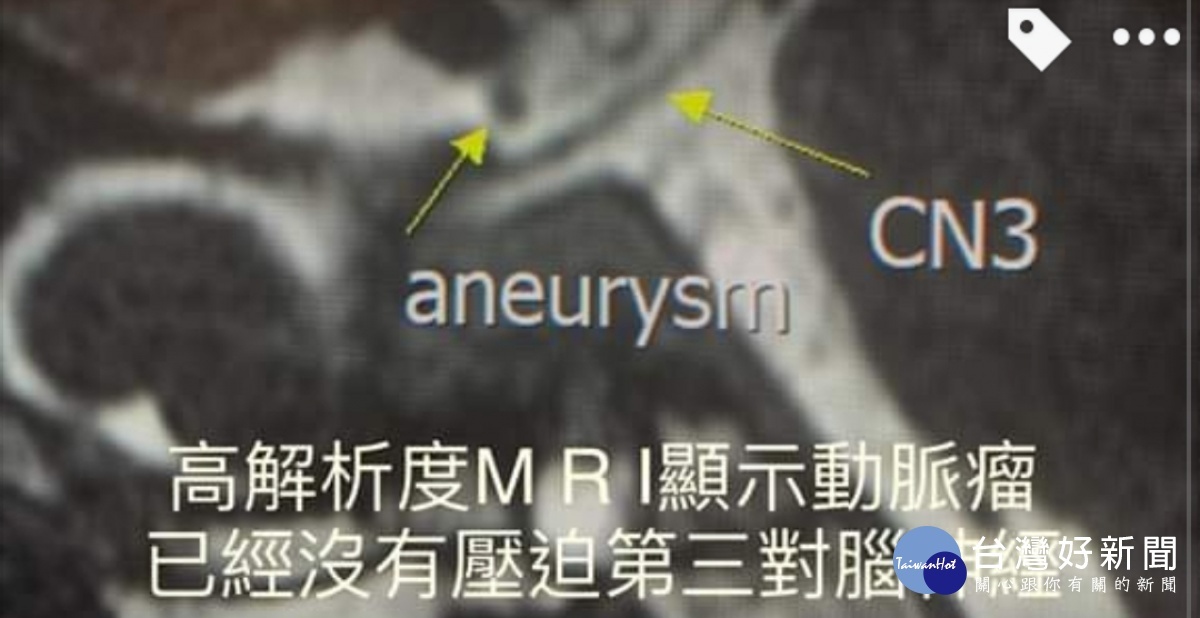 舉杯邀明月對影成三人 腦血管動脈瘤不可不慎