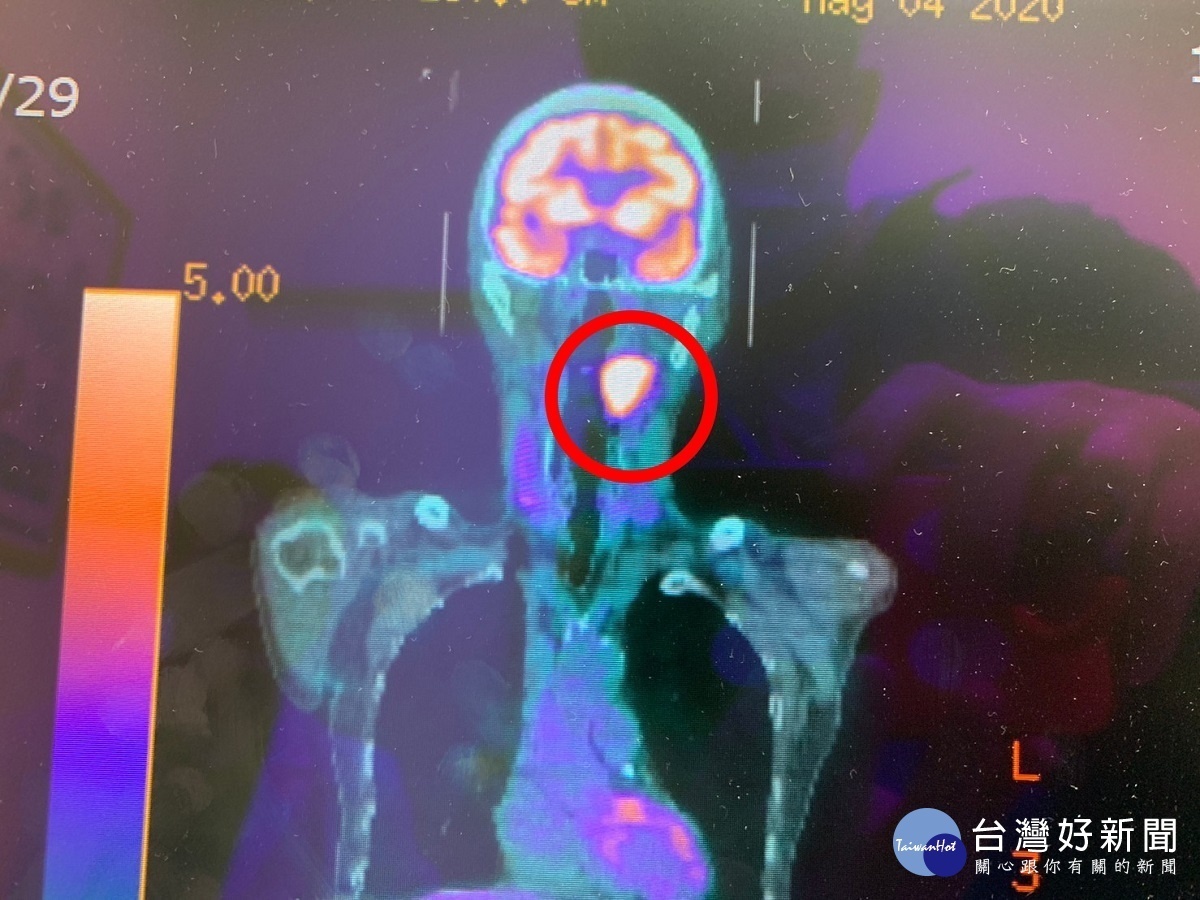 口咽癌可能伴隨耳部移轉 醫師:恐被誤認為中耳炎民眾要多加留意