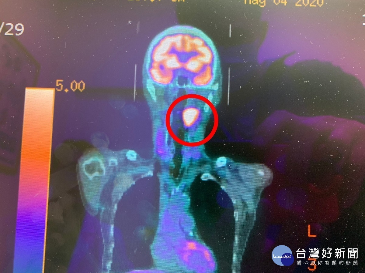 口咽癌可能伴隨耳部移轉　醫師：恐被誤認為中耳炎民眾要多加留意